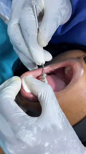 Braces maintenance day! 🦷 A quick bracket and archwire replacement to keep the teeth moving perfectly into place. Consistency is key to achieving that perfect smile! #PrimeDentalClinic #OrthodonticCare #HealthySmile #fyp