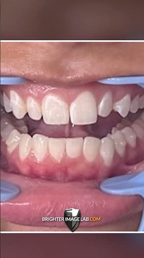 Do Brighter Image Lab Veneers Really Last? See My Results!
