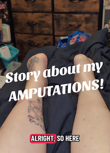My Amputation Journey: Embracing Change and Resilience