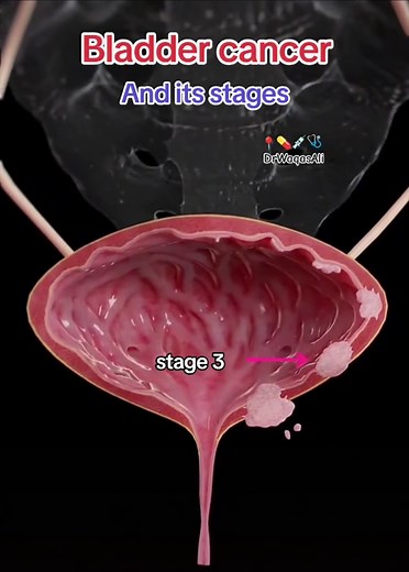 Bladder Cancer Overview: Types and Risk Factors