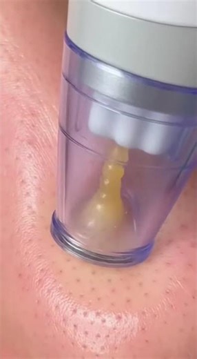 The MOST SATISFYING Pore Extraction You'll EVER See!