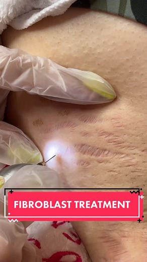 Fibroblast treatment for stretchmarks removal (left underarm).This is very effective and fast results.FB PAGE, Magical Lashes & Facial Center.