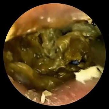 Explore Ear View | Satisfying Earwax Removal & Ear Cleaning Close Up