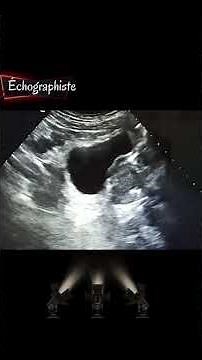 Échographie de la prostate