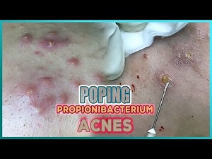 Big Cystic Acne Blackheads Extraction Blackheads & Milia, Whiteheads Removal Pimple Popping