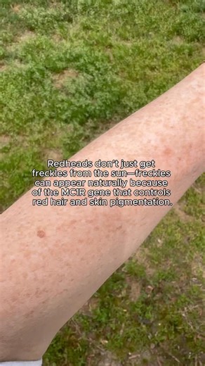 How to be a Redhead® on Instagram: "Freckles aren’t just for sunny days! 🌞✨ Did your redhead freckles appear naturally, or after some time in the sun? ❤️"