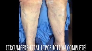 Leg Liposuction Treatment Options and Results (GRAPHIC)