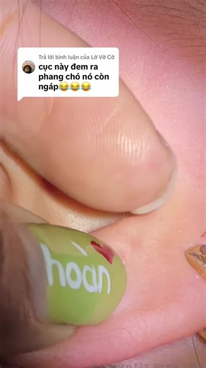 Expert Ear Wax Removal Techniques for Clear Hearing