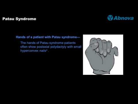 Patau Syndrome