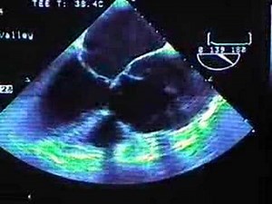 Diagnosis of aortic dissection by TEE