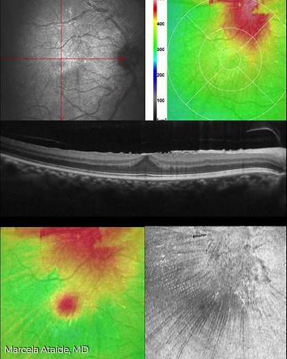 Epiretinal Membrane En-Face OCT Analysis