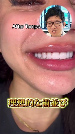 ラミネートベニア治療を先生が説明！【吉岡歯科医院】