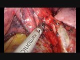 Uniportal VATS left upper lobectomy • Video • MEDtube.net