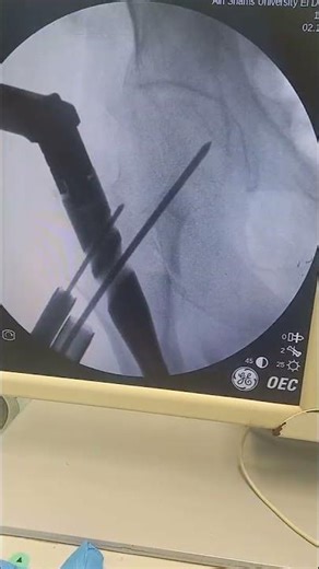 proximal Femoral Nailing