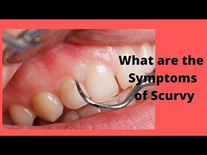 What are the Symptoms of Scurvy