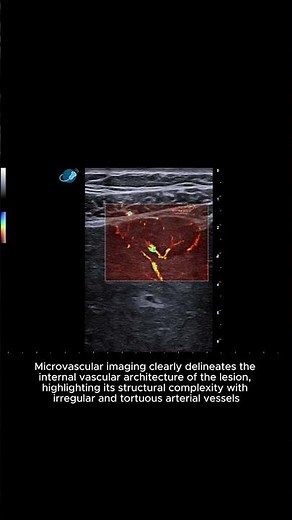 Liver - Hepatocellular carcinoma - Heterogeneous nodular lesions - Clip 1 B-mode + Color + microV