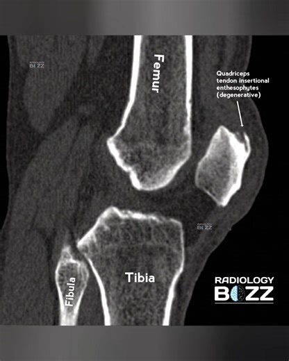 These images show well-defined quadriceps and patellar tendon enthesophytes—a classic sign of chronic traction and degenerative stress at tendon insertion sites. Recognizing these features is essential to avoid misdiagnosis, especially when distinguishing chronic enthesophytes from acute avulsion injuries. 🔍💡 --- 🦴 What Are Enthesophytes? Enthesophytes are bony outgrowths that form at the tendon or ligament insertion site (enthesis). They develop due to repetitive stress, degeneration, aging,