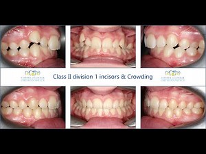 Class II occlusion & mild crowding - Elastics & clear ceramic braces