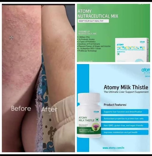 🌟 The Ultimate Glow-Up Duo: Gut & Liver Power! 🌟 Say goodbye to dull skin and hello to a healthier you! 🚀 When your internal health is on track, it shows on the outside. Our Atomy Nutraceutical Mix and Milk Thistle are the secret weapons you’ve been waiting for! 🛡️✨ 🍏 Atomy Nutraceutical Mix (Probiotics) Keep your gut happy and your immunity strong! 🛡️ * ✨ 3 Billion CFUs for maximum potency. * 🧬 14 Probiotic Strains to balance your gut flora. * 🍎 3 Types of Prebiotics (The fuel your good