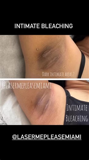 FLAWLESS ICON | Health & Wellness Specialist | Miami on Instagram: "Intimate area lightening is a process of bleaching the hyperpigmented (darker) skin of the surrounding of the vaginal/ genital / anal or any areas to create an even skin tone that is cohesive over the entire body. This hyperpigmentation is completely normal and is the result of melanin, the pigment found in the skin. Also, shaving makes the hairs come back thicker and darker. ... To avoid the stubbly look you can get from shavin
