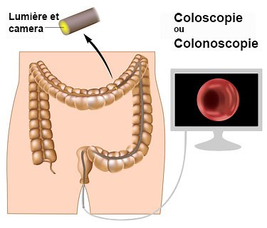 Coloscopie ou colonoscopie examen