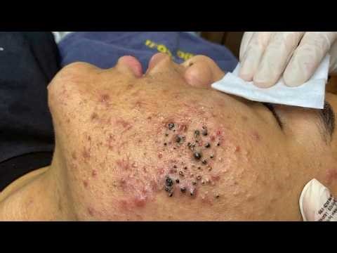 Blackhead removal with Sac Dep Spa | Satisfying and Relaxation with Sac Dep Spa #356254