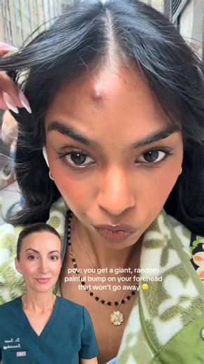 🙌 This is how it’s DONE. As a board-certified derm, I see way too many cyst horror stories online — people picking, popping, and applying who-knows-what, only to end up with scars or infections. This video? A total win. 💯 A quick steroid injection from a professional brings that cyst down in just a day or two — no popping, no scarring, no risky DIY treatments. 💡 Moral of the story: When in doubt, see a dermatologist. The right treatment at the right time can make ALL the difference. Video Cre