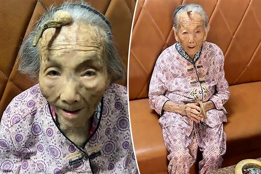 Woman lives to 107 despite 4-inch ‘longevity horn’ growing from her forehead
