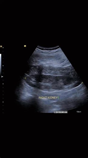 Radiology @all abnormalities 🥏🥏 on Instagram: "Ultrasound Kidneys Report Clinical Presentation 30-year-old male with right-sided abdominal pain radiating to the back. Findings Kidneys / Renal Fossa: Left kidney not visualized in the left renal fossa Right kidney enlarged, showing a posterior notch Both renal poles appear fused / contiguous (suggestive of crossed fused ectopia) Preserved corticomedullary differentiation No hydronephrosis or calculi Other Abdominal Organs: Liver, spleen, pancrea