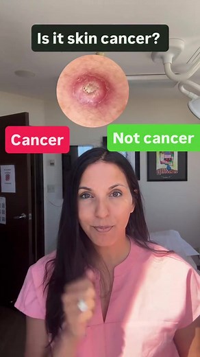 Cancer or not? Squamous cell carcinoma, sk, cherry angioma! #scc #sk #skincancer