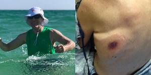 Tennessee Man Dies Just 48 Hours After Contracting Flesh-Eating Bacteria in Florida