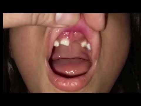 Frenectomy