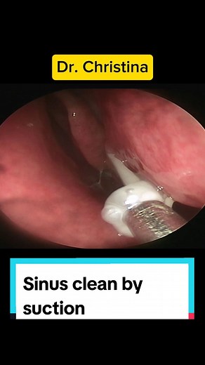 Removal of sticky booger by endoscopic suction method #boogerremoval #booger #sinuscleaning #suction #endoscopy #viralvideo