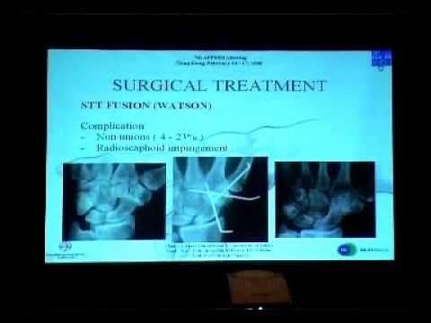 Arthroscopic Scaphoid Trapezium Trapezoid arthritis treatment