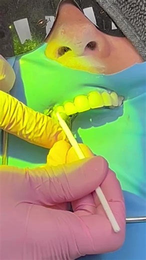 Biockear rejuvenation—#bioclear #bioclearmethod #biocleardoctor #bioclearmontreal #montrealdentist #dentistemontreal #cosmetic #cosmeticmakeover #cosmeticdentist #smilemakeover #smilemakeovers #dentalveneers #veneers #complexedesjardins #invisalign #invisalignjourney #invisaligndoctor #invisalignsmile #girlboss #womenindentistry #womendentist #dentalbosslady @Complexedesjardins @Bioclear Matrix System @invisalign @MTL Bioclear Clinic