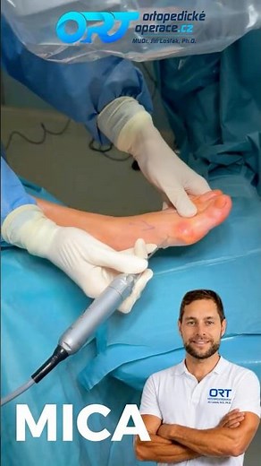 🦶 Minimally Invasive Bunion Correction (MICA)