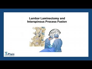 Lumbar Laminectomy and Interspinous Process Fusion