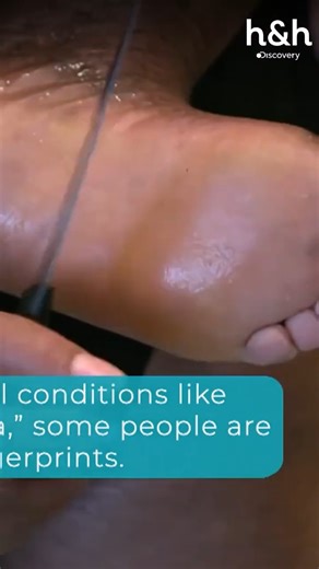 Tamyra vive con ictiosis vulgar, una condición que provoca resequedad y descamación en la piel 🩺 #DraSandraLeeEspecialistaenPiel | Discovery Home & Health