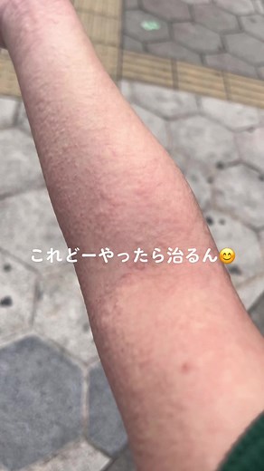 温熱蕁麻疹と寒冷蕁麻疹の治療法