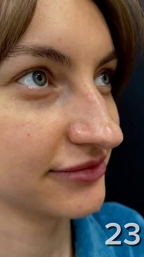 Efter sin næseoperation ændrede denne pige sig fuldstændigt og blev uigenkendelig. | Alt om livet