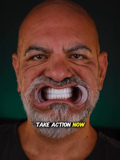 𝐇𝐨𝐥𝐥𝐲𝐰𝐨𝐨𝐝 𝐒𝐦𝐢𝐥𝐞 𝐢𝐧 𝐓𝐮𝐫𝐤𝐞𝐲 🇹🇷✈️ Get the smile you've always wanted — in just 5 days — at Dr. Bahar Doğan Clinic, located in the heart of Istanbul, Turkey 🇹🇷✈️ You’ll receive a complete Hollywood Smile makeover with 𝟐𝟎 𝐳𝐢𝐫𝐜𝐨𝐧𝐢𝐮𝐦 𝐜𝐫𝐨𝐰𝐧𝐬 or 𝐯𝐞𝐧𝐞𝐞𝐫𝐬. Plus an ALL-INCLUSIVE PACKAGE INCLUDES: 🎁 ✔️ Zircoinum Crowns/Veneers (20 Teeth) ✔️ Luxury Hotel Accommodation ✔️ VIP Airport Pick-up ✔️ Private English-Speaking Interpreter ✔️ All Medical Examinations &