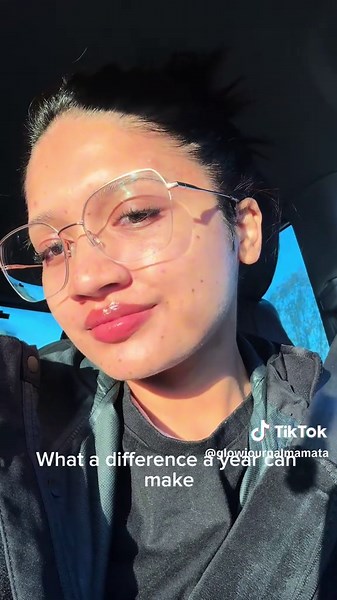 Overcoming Cystic Acne: My Healing Journey