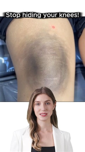 Laser Treatment to Brighten Dark Knees ✨ Smooth, Even & Glowing Skin!