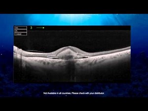 Topcon Swept Source OCT by Prof. Paulo Stanga