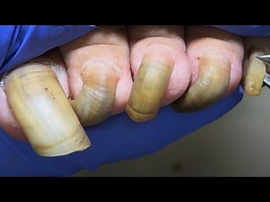 Super Long Black Toenails, They Haven’T Been Trimmed For Too Long!【Podiatry Clinic】