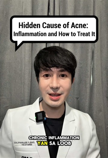 Understanding Inflammation as a Cause of Acne