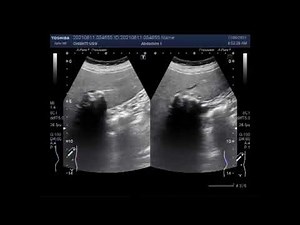 Calcified Hepatic Mass.