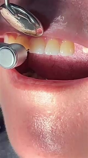 Murang Pustiso at Fixed Bridge: Quality Dental Services