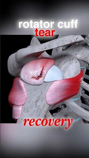 Rotator Cuff Tear? Do These Exercises Before It Gets Worse