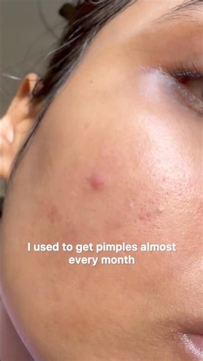 Plix Jamun Active Acne Juicy Cleanser review | Pimples solution | Facewash for Oily Acne Prone Skin
